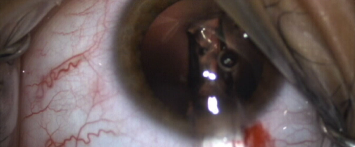 Chirurgia refrattiva con impianto di lenti fachiche ICL VISIAN