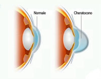 01-cheratocono