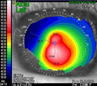 03-topografia-tomografia-corneale