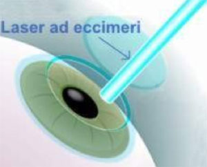 01-laser-a-eccimeri